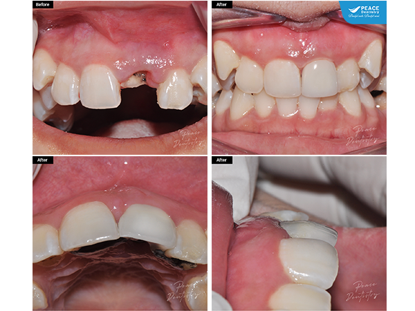 cấy ghép Implant cho nữ khách hàng 22 tuổi gặp chấn thương sau tai nạn