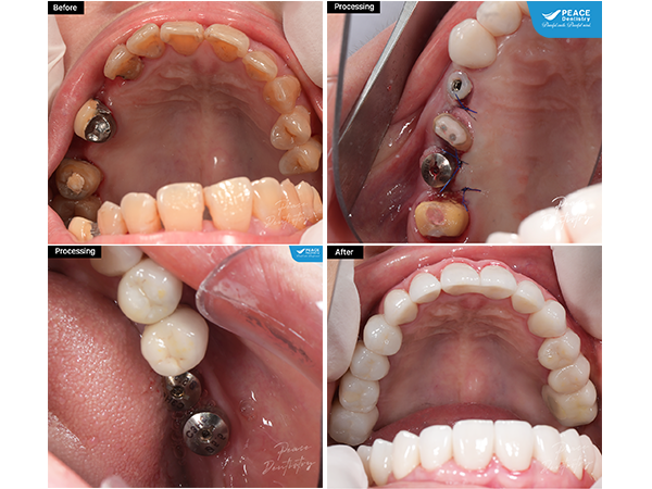 cấy ghép Implant cho khách hàng bị suy giảm chức năng ăn nhai do mất răng hàm nhiều năm, men răng yếu