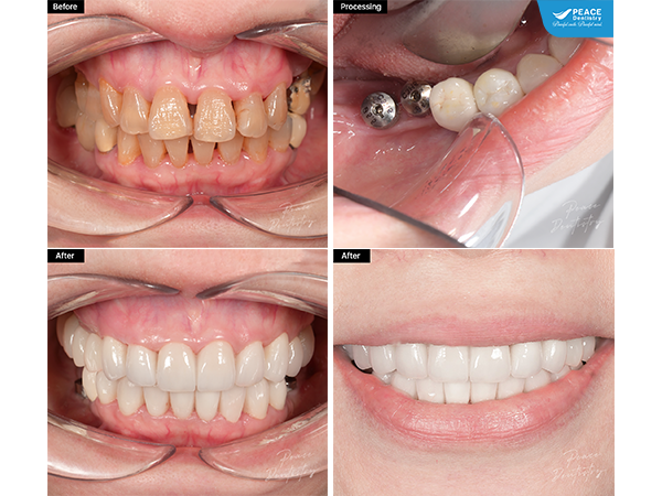 cấy ghép Implant kết hợp thẩm mỹ sứ toàn hàm khôi phục răng mất, răng sẫm màu