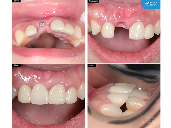 cấy ghép Implant khắc phục lỗi từ nha khoa khác