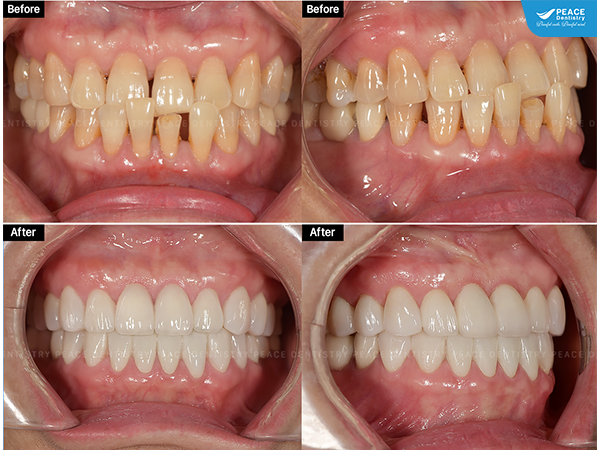 cấy ghép Implant khôi phục răng mất, ngăn ngừa tiêu xương, kết hợp với mặt dán sứ Veneer IPS e.max Press