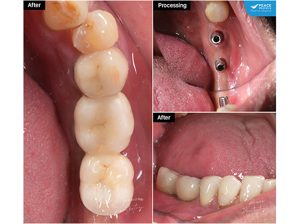 Phục hình răng trên Implant khôi phục chức năng ăn nhai tốt