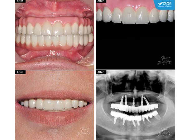 Trồng răng Implant toàn hàm All-On-5 hàm trên và All-On-4 hàm dưới