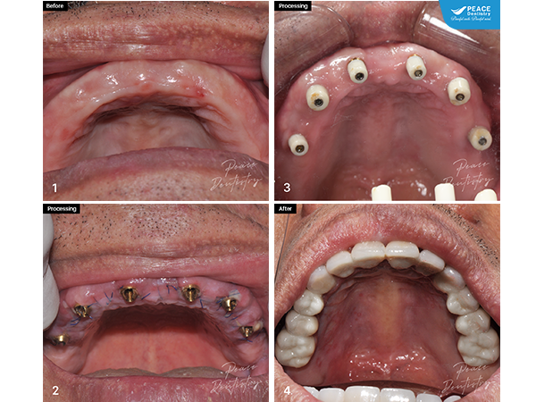 trồng răng Implant All-on-6 cho hàm trên