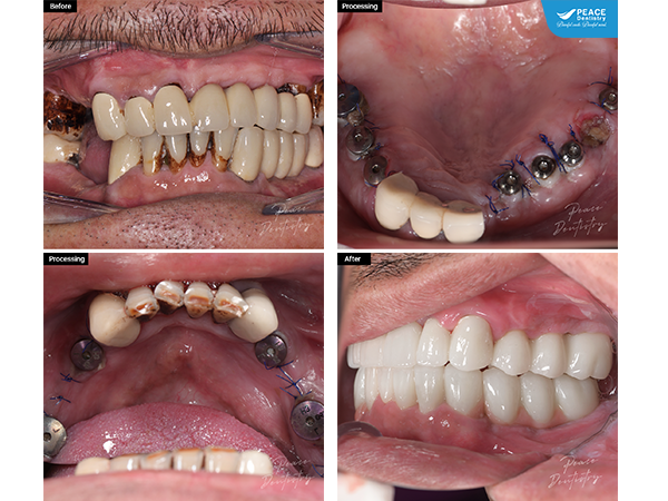 trồng răng Implant thay thế cầu răng sứ lâu năm
