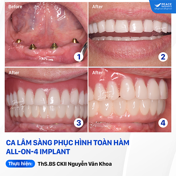 ca lâm sàng implant toàn hàm all on 4