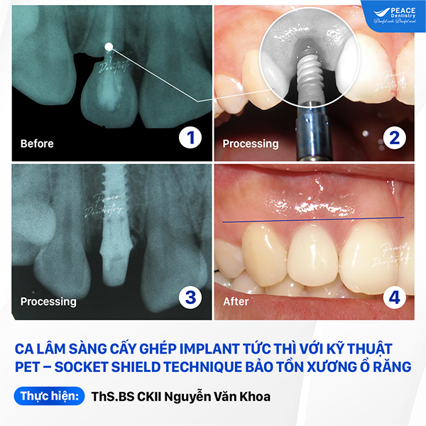 ca lâm sàng implant tức thì với kỹ thuật pet socket shield teachnique