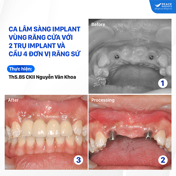 ca lâm sàng implant vùng răng cửa với 2 trụ implant, cầu 4 răng sứ