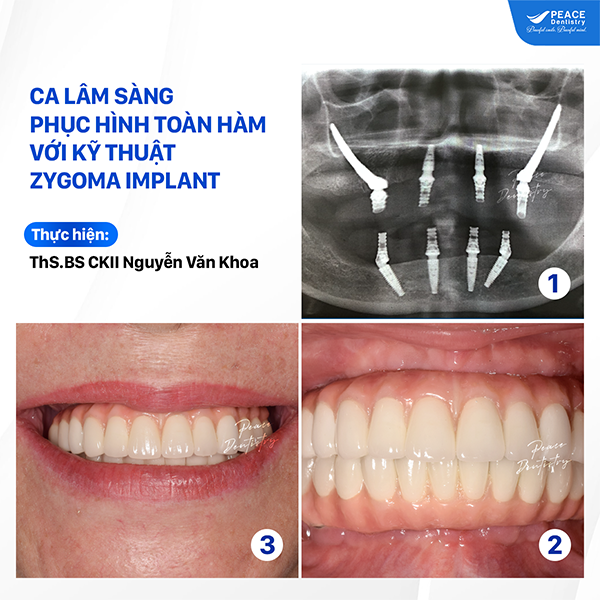 ca lâm sàng phục hình toàn hàm với implant zygoma xương gò má