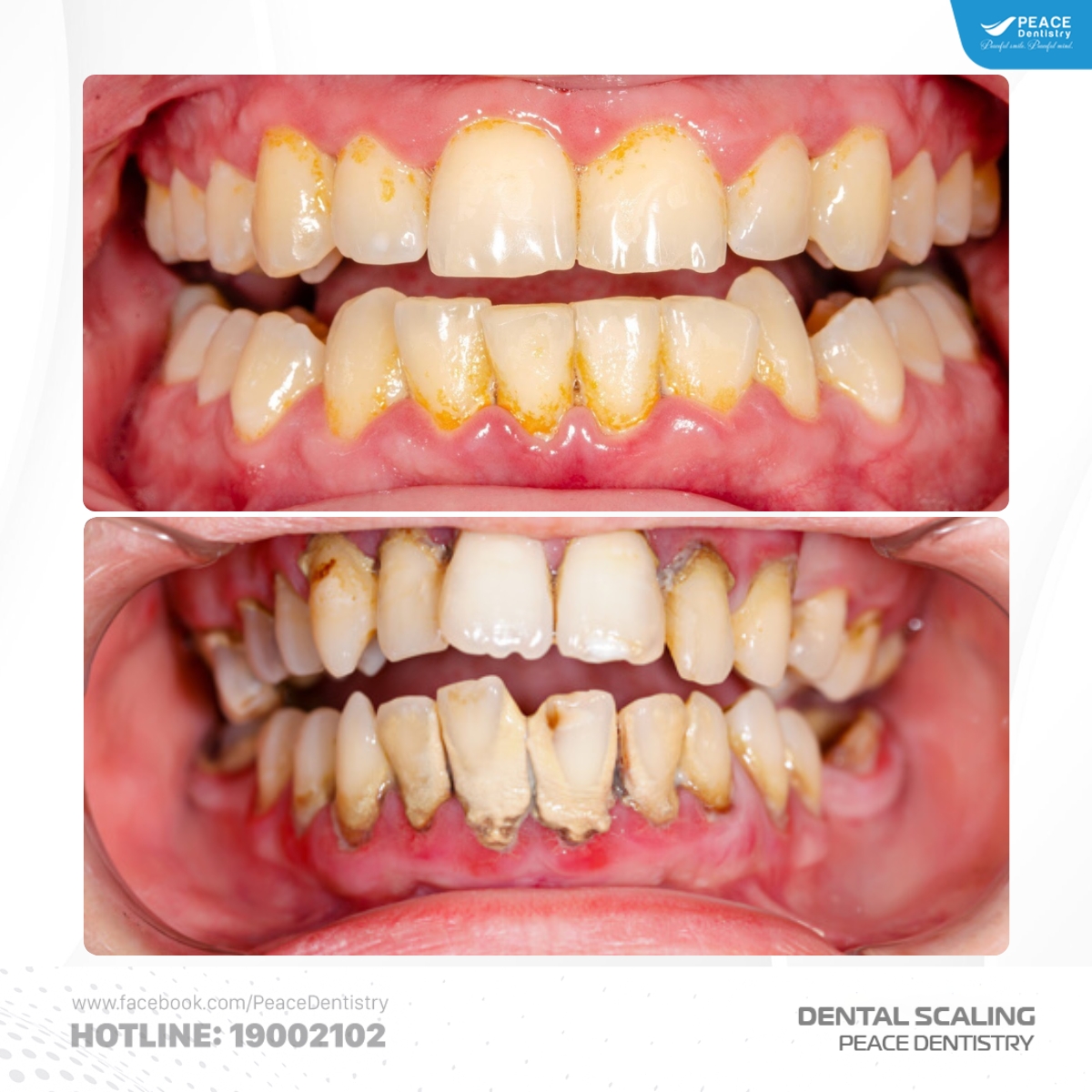 các loại cao răng