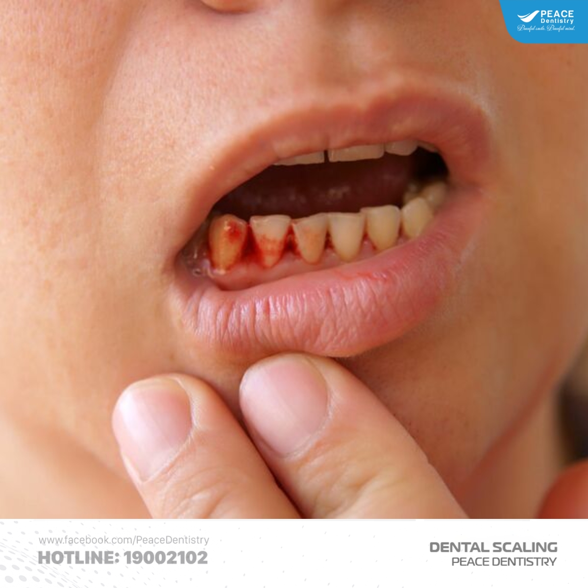 cao răng huyết thanh có nguy hiểm không