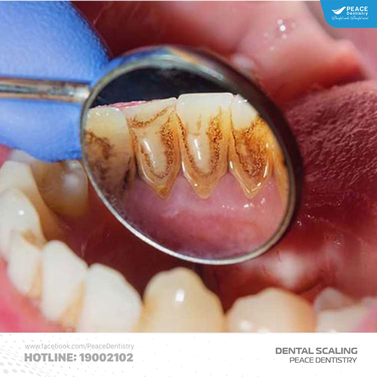 cao răng màu năm sẫm