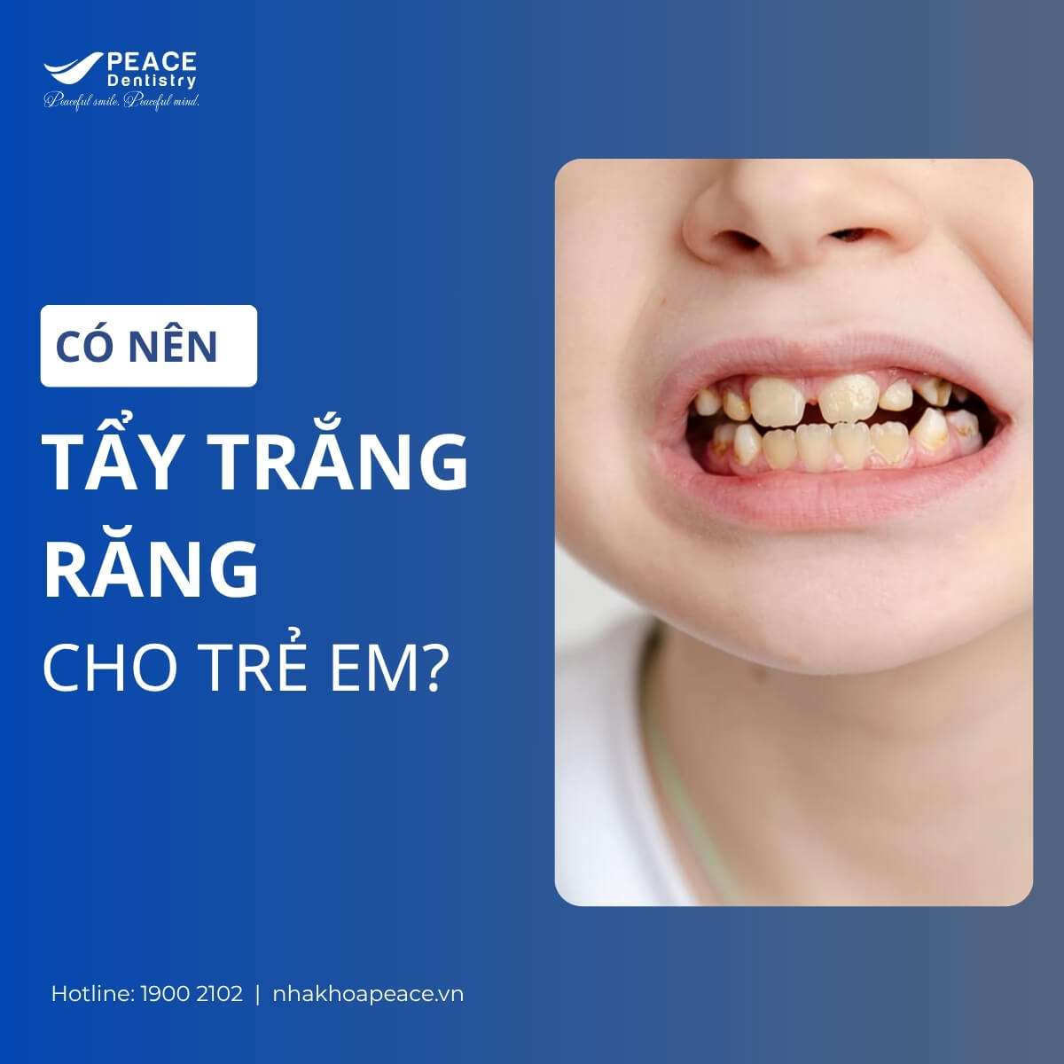 có nên tẩy trẳng răng cho trẻ em hay không
