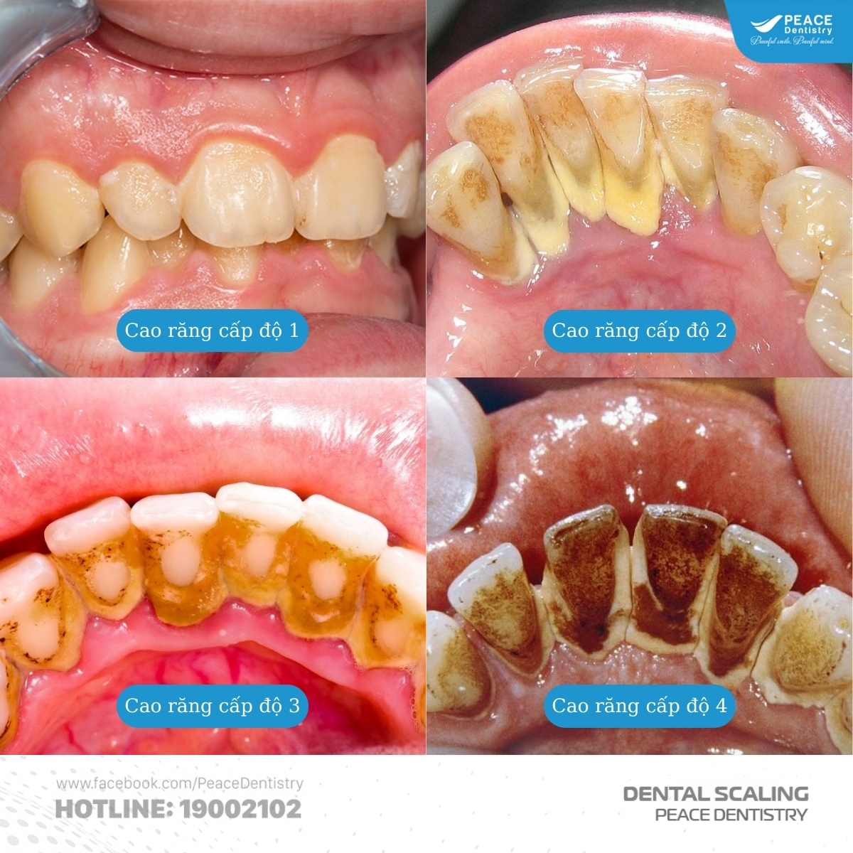 phân độ cao răng