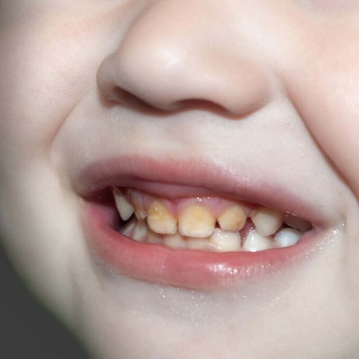 vì sao răng bé hay bị ố vàng