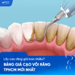 bảng giá cạo vôi răng