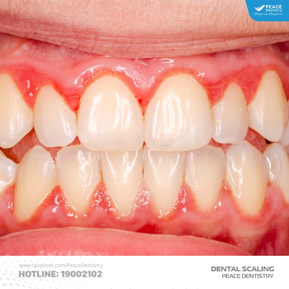 cảm giác răng thưa sau khi cạo vôi