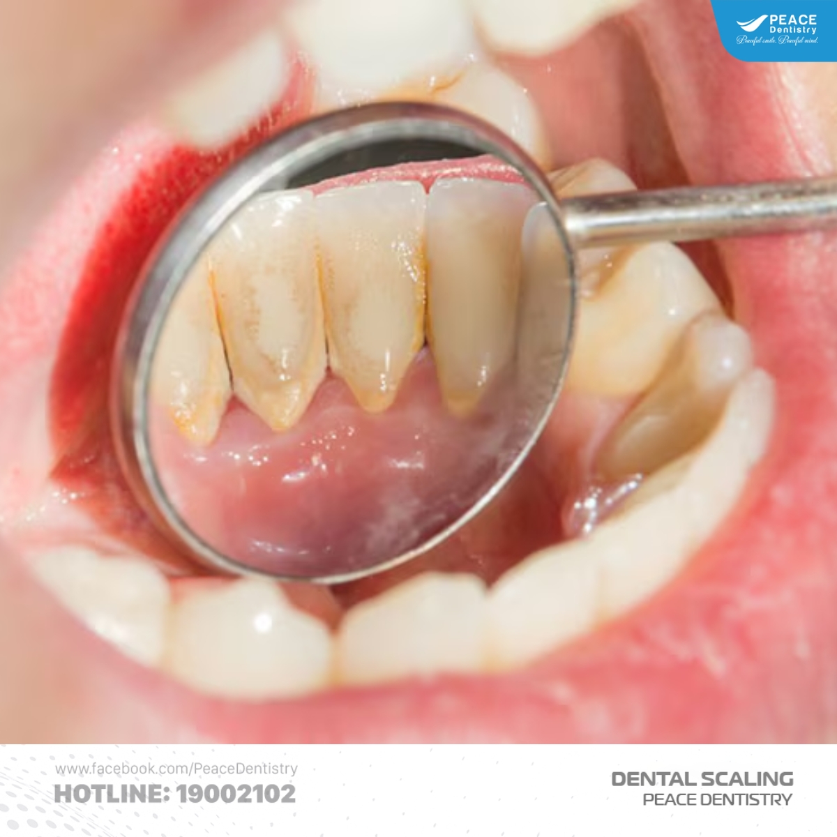 cao răng cấp độ 1