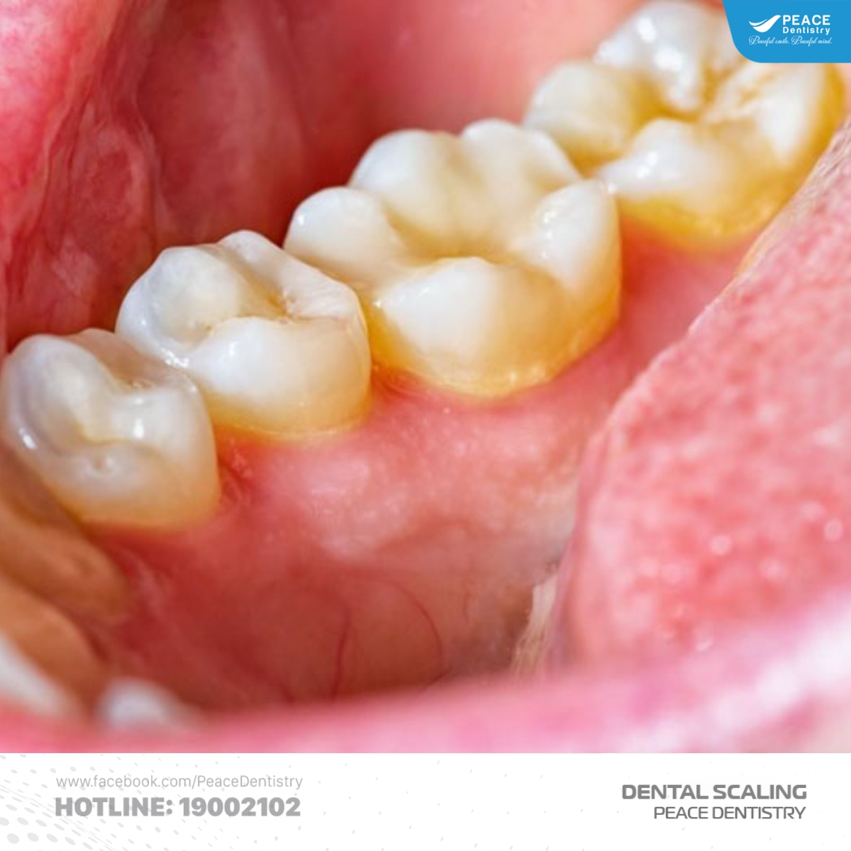 cao răng dưới nướu