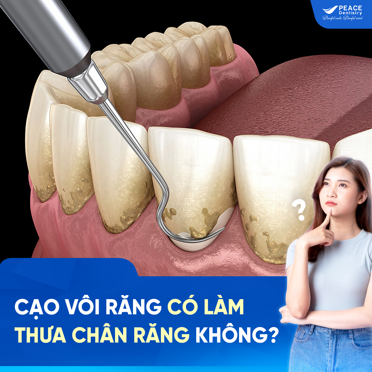 cạo vôi răng có làm thưa chân răng không