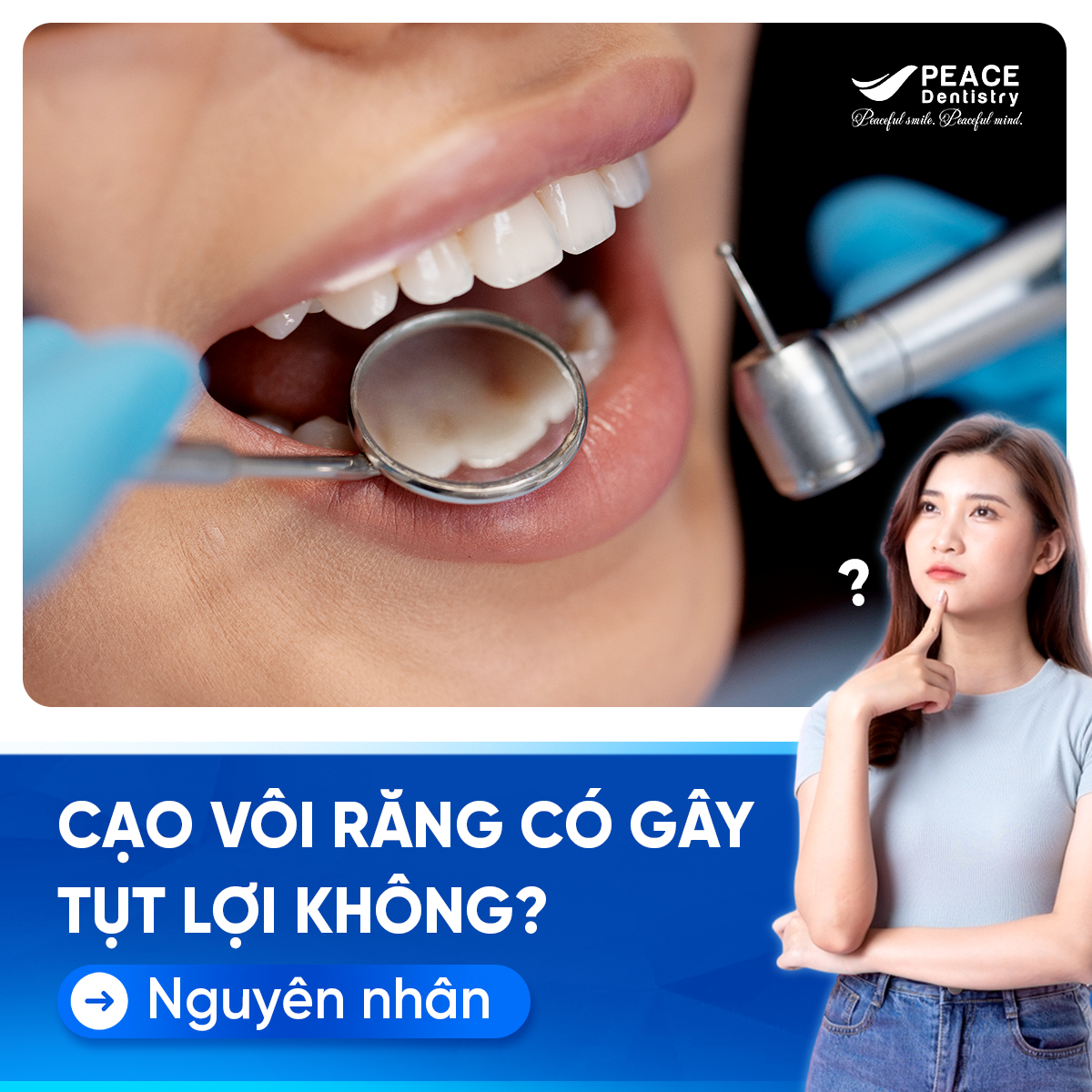 cạo vôi răng có gây tụt lợi không