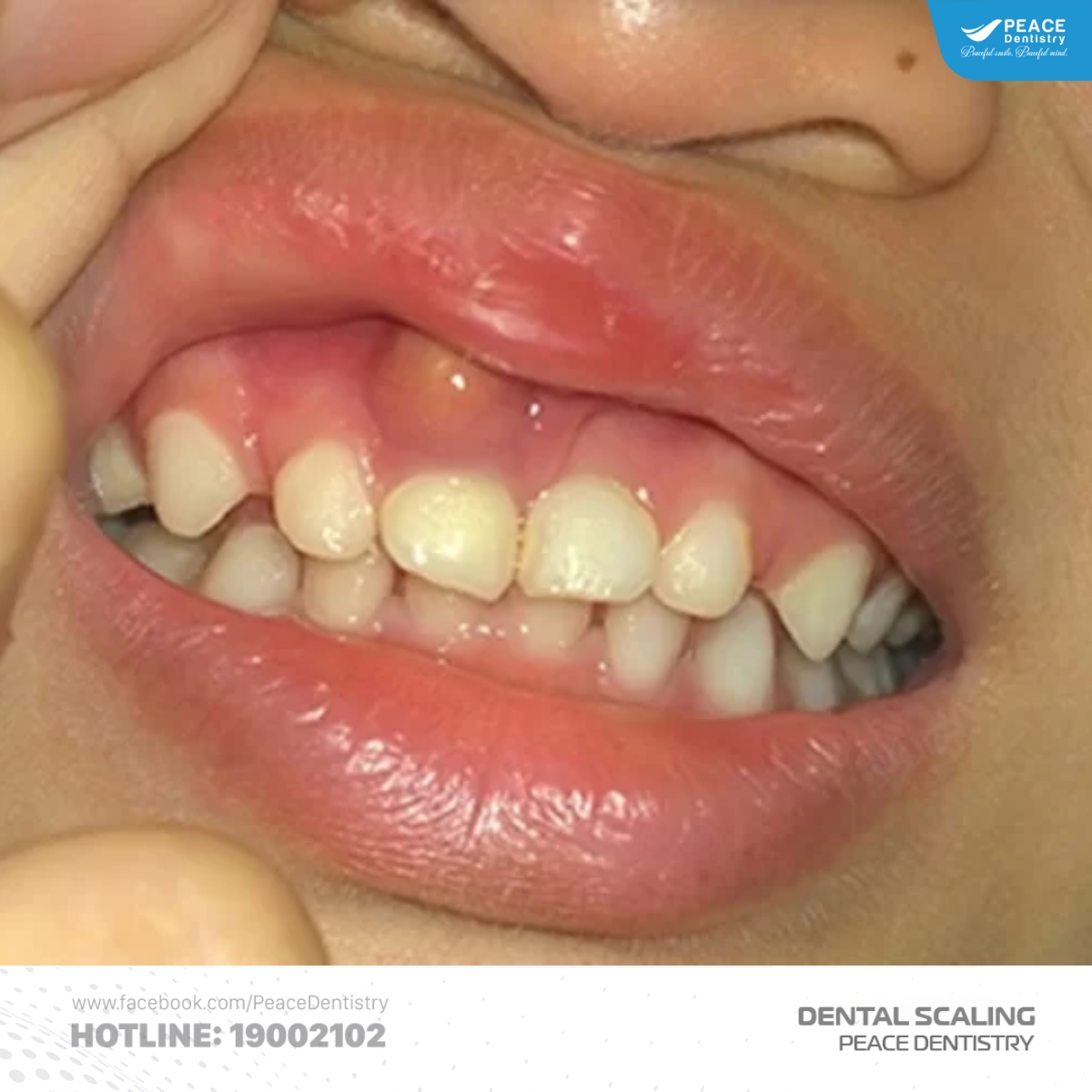 cạo vôi răng điều trị nha chu 4