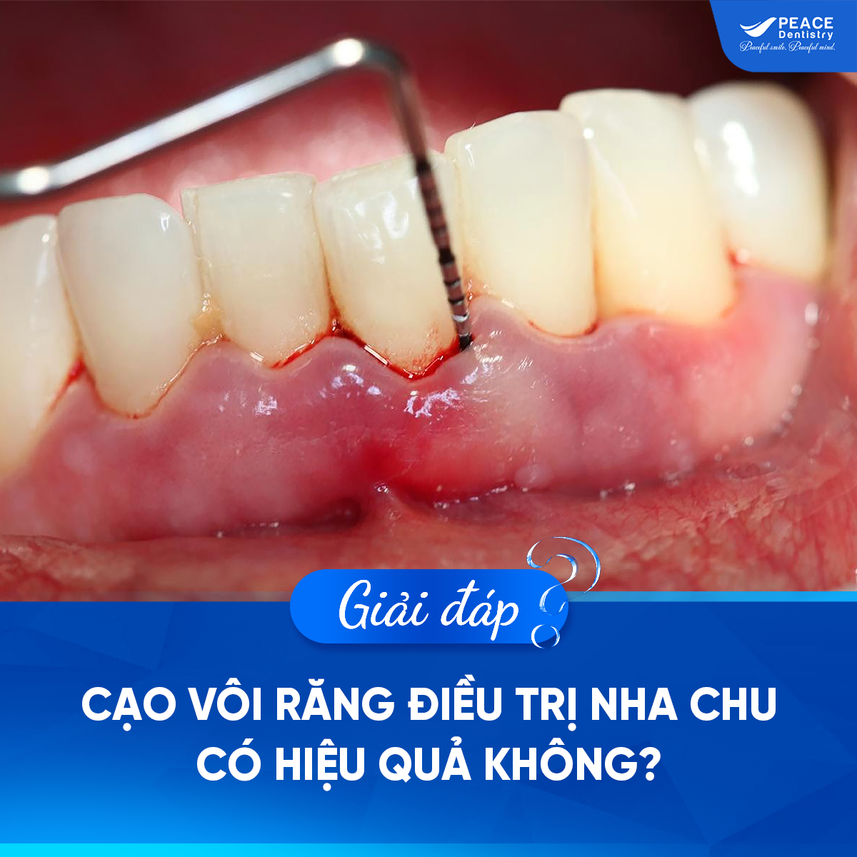 cạo vôi răng điều trị viêm nha chu