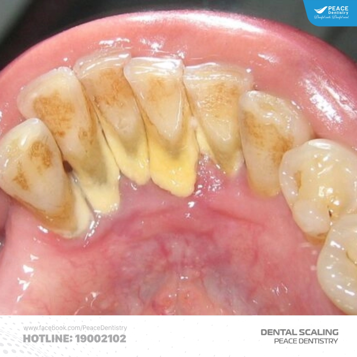 chi phí lấy cao răng tùy thuộc vào mức độ