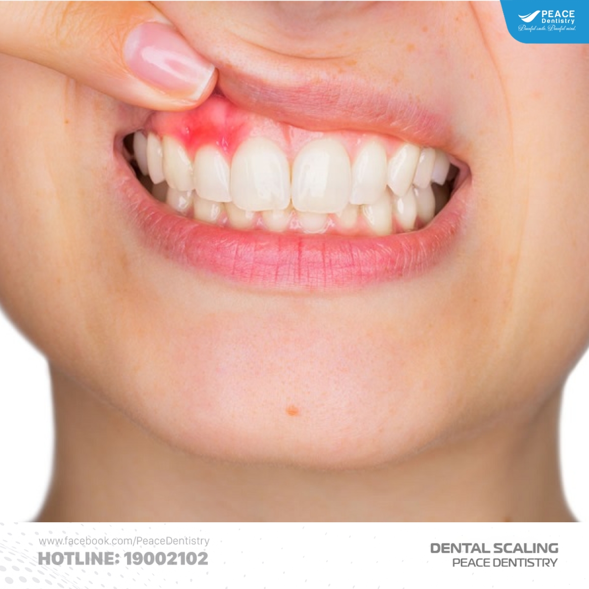 dấu hiệu nhận biết cao răng cấp độ 1