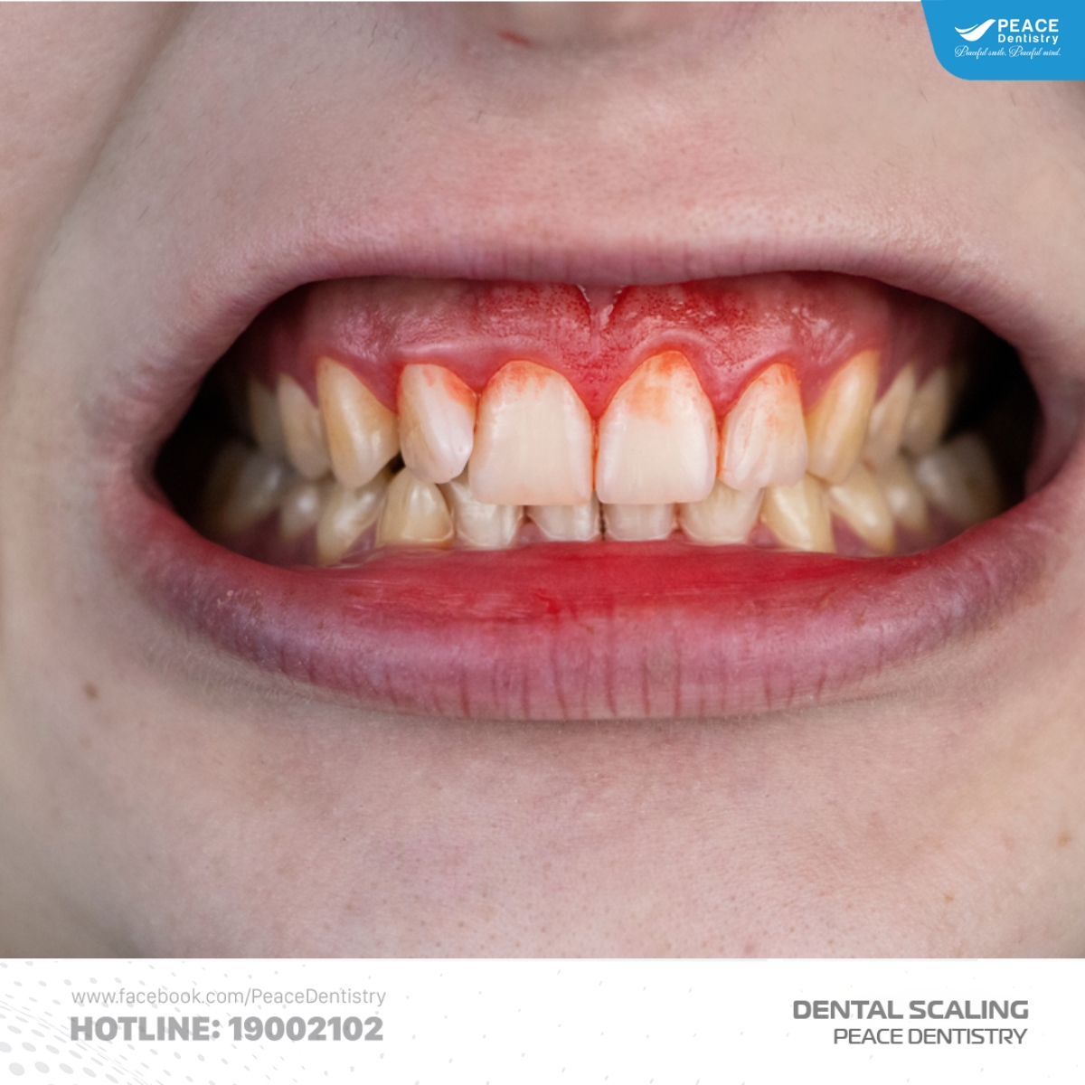 dấu hiệu nhận biết vôi răng dưới nướu