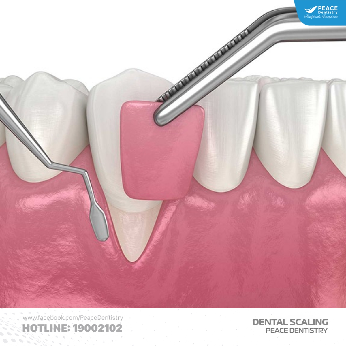 điều trị tụt lợi tại nha khoa uy tín