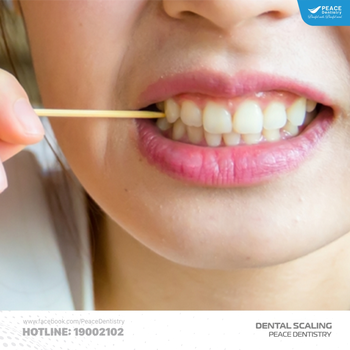 nguyên nhân khiến răng thưa