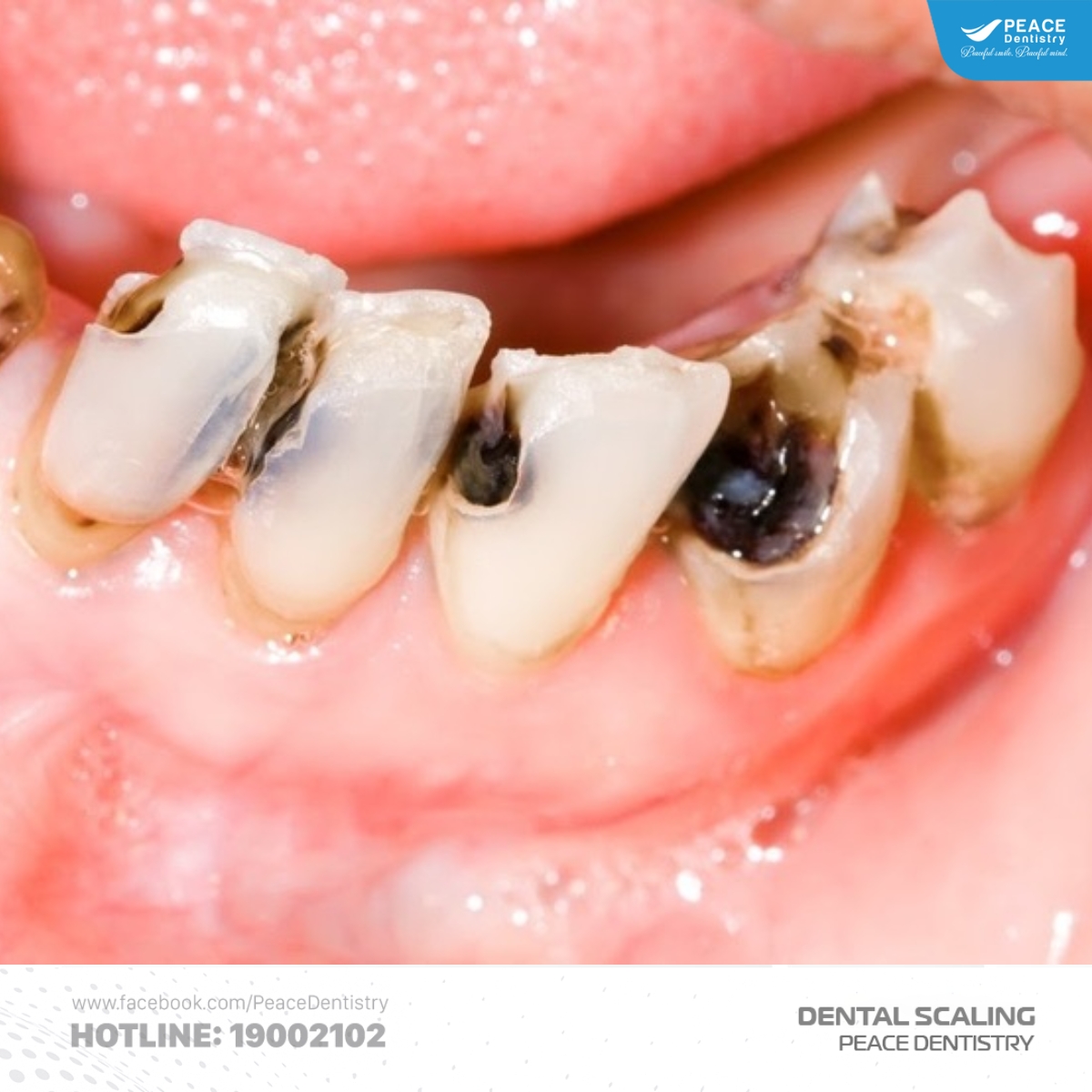 rủi ro khi không điều trị cao răng cấp độ 1