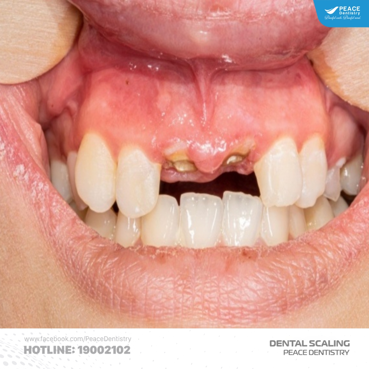 vì sao cần loại bỏ cao răng độ 1