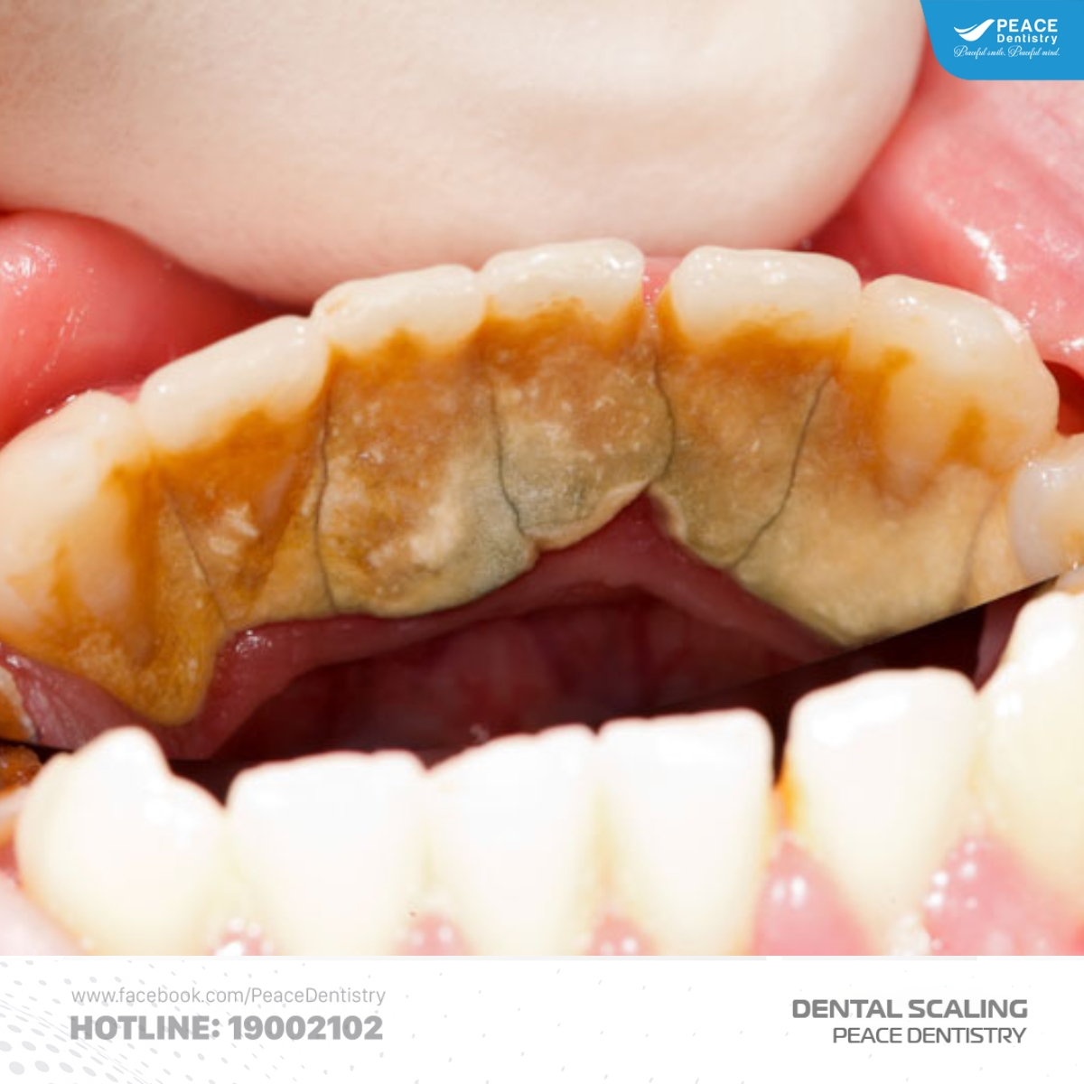 vì sao sau lấy cao răng lại có cảm giác tụt lợi