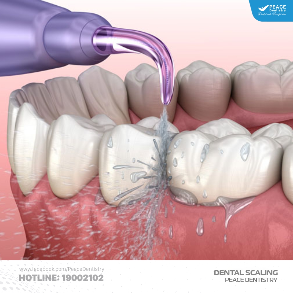 vôi răng bị vỡ xảy ra khi nào