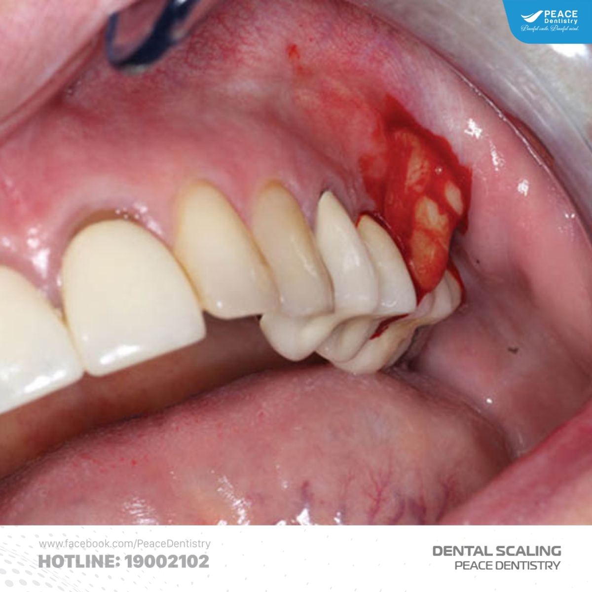 vôi răng dưới nướu có nguy hiểm không