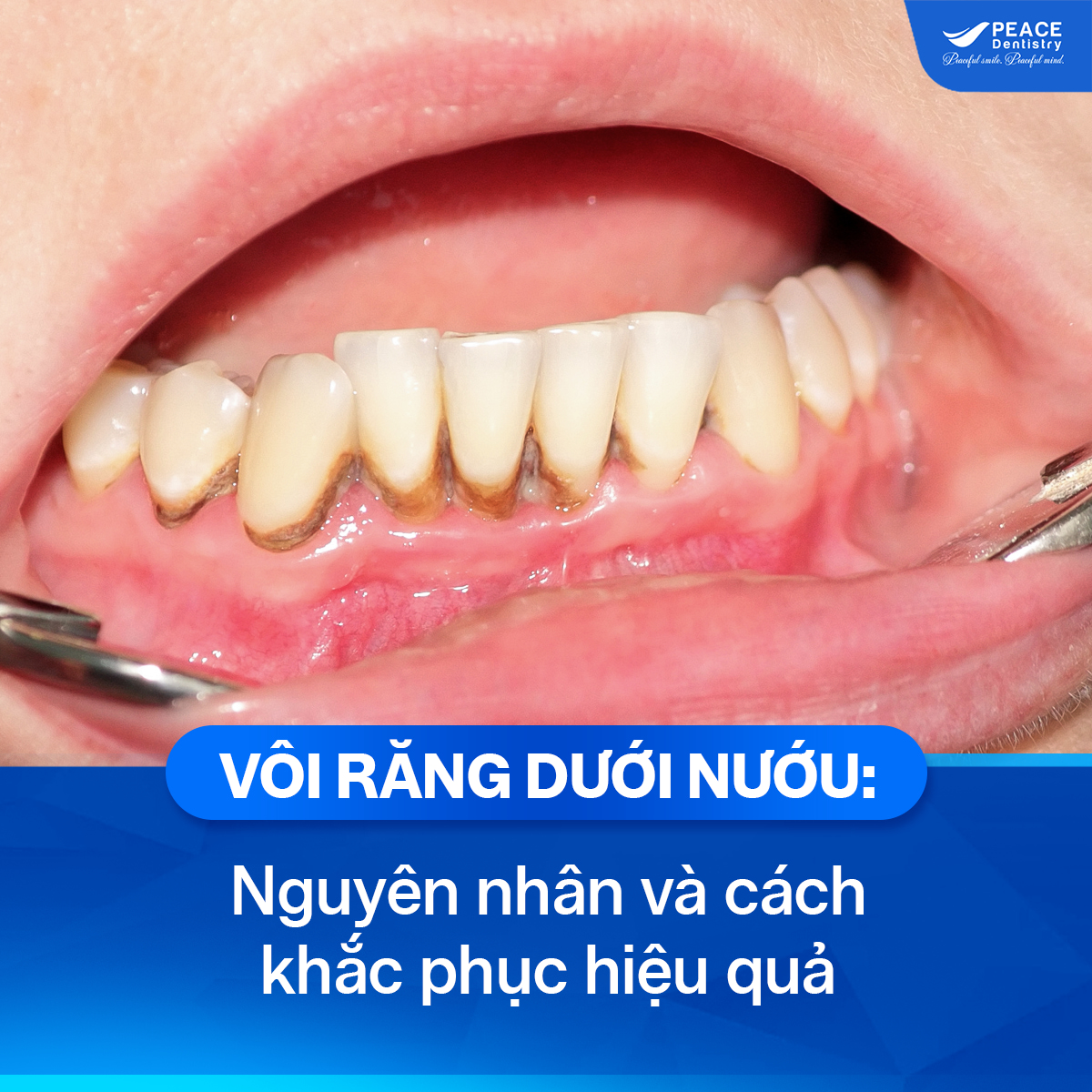 vôi răng dưới nướu