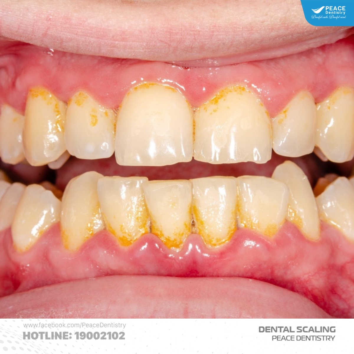 vôi răng hình thành từ mảng bám