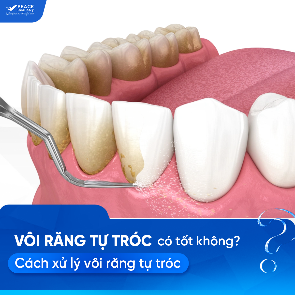 vôi răng tự tróc