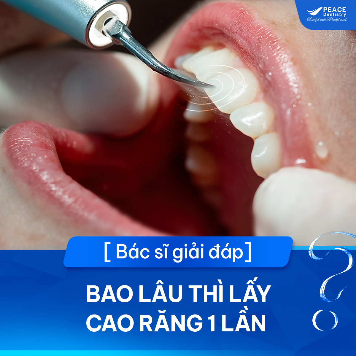 bao lâu lấy cao răng 1 lần