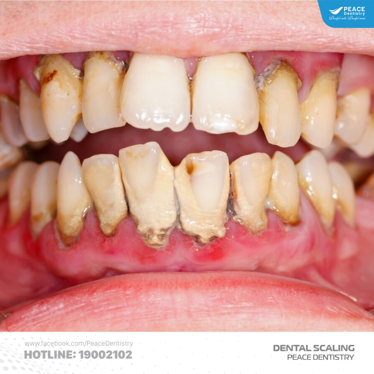 biến chứng cao răng độ 4