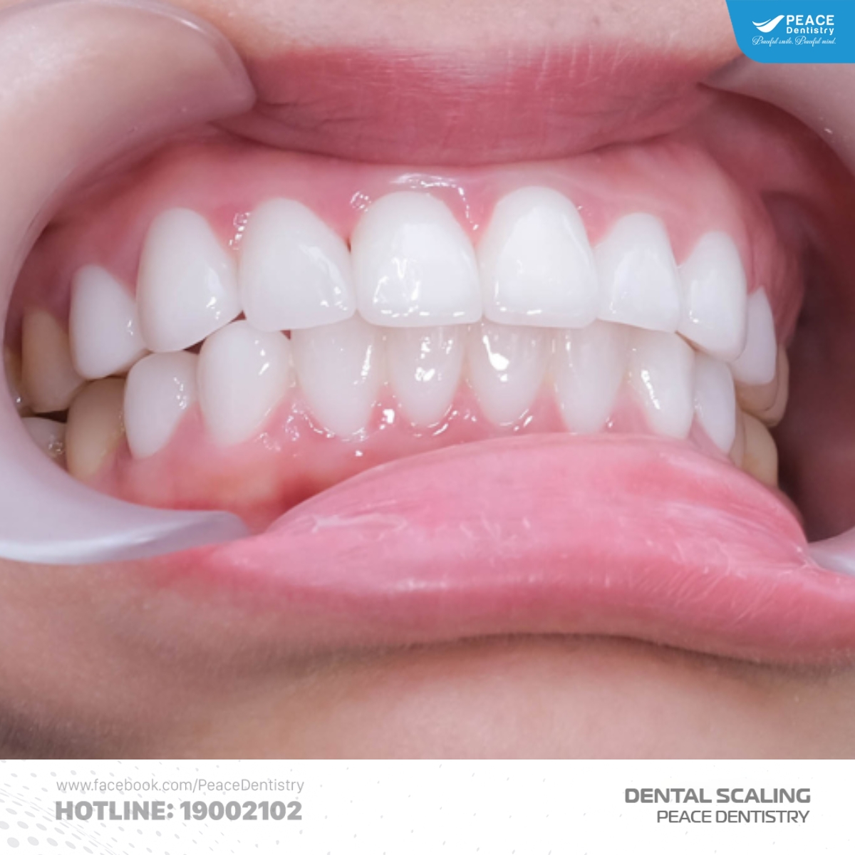 bọc răng sứ bao lâu nên lấy cao răng