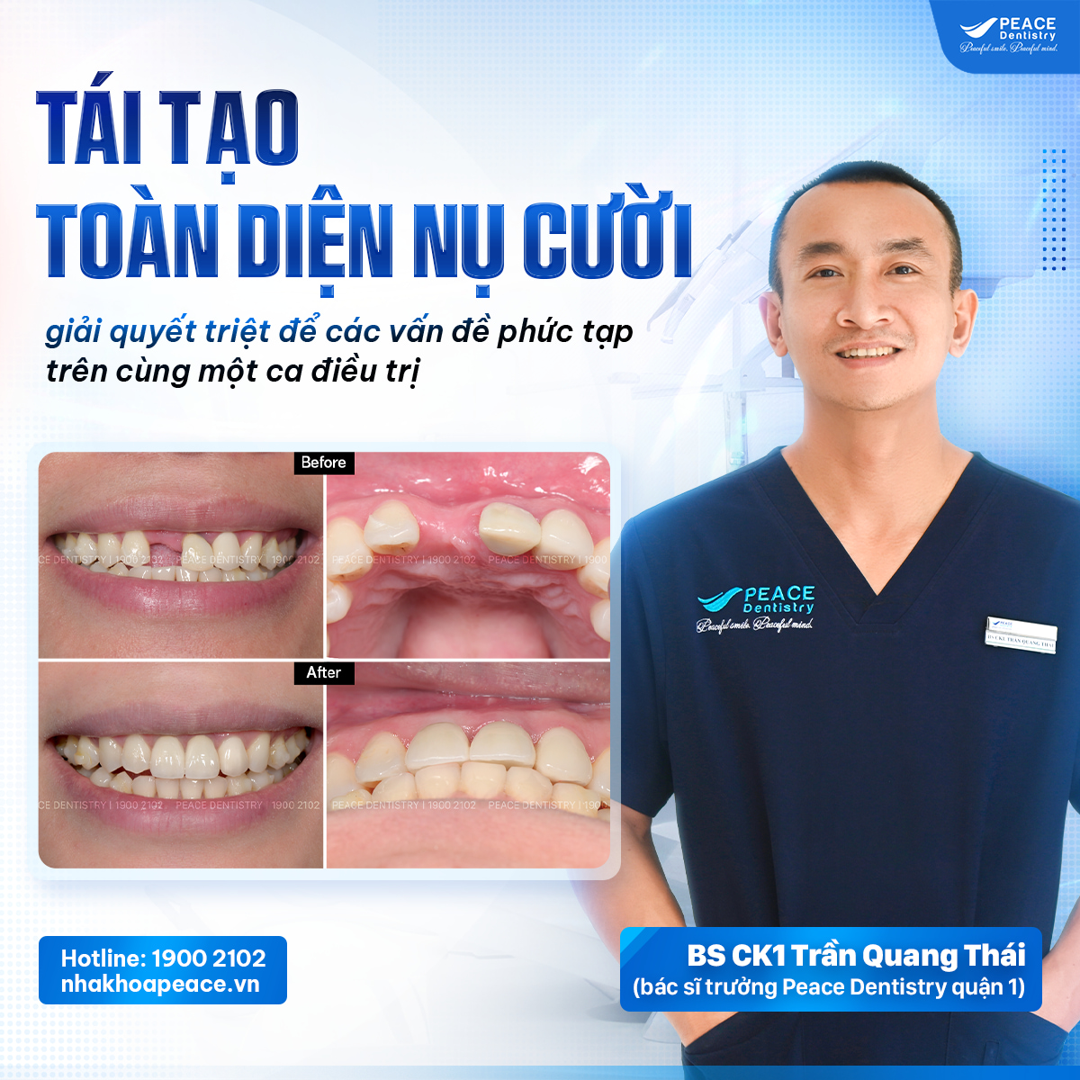 ca lâm sàng niềng răng kết hợp trồng răng implant
