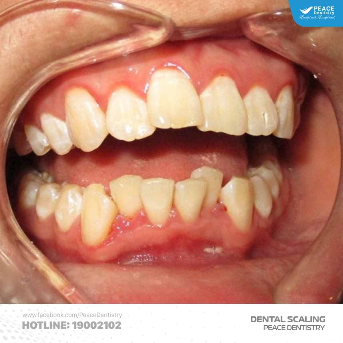 các yếu tố ảnh hưởng đến thời gian lấy cao răng