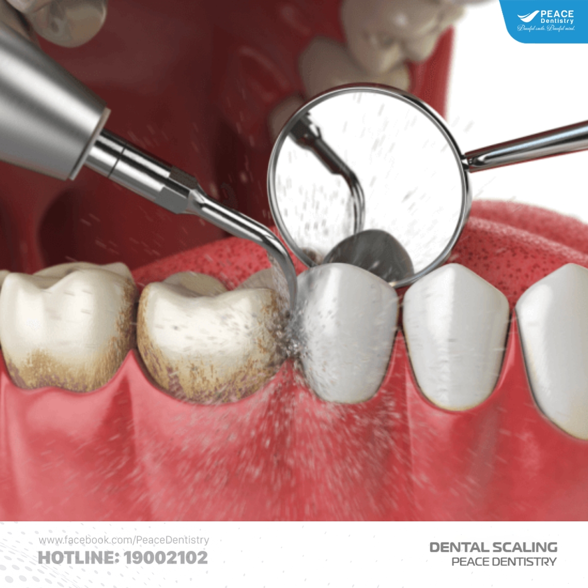 cách điều trị vôi hóa chân răng