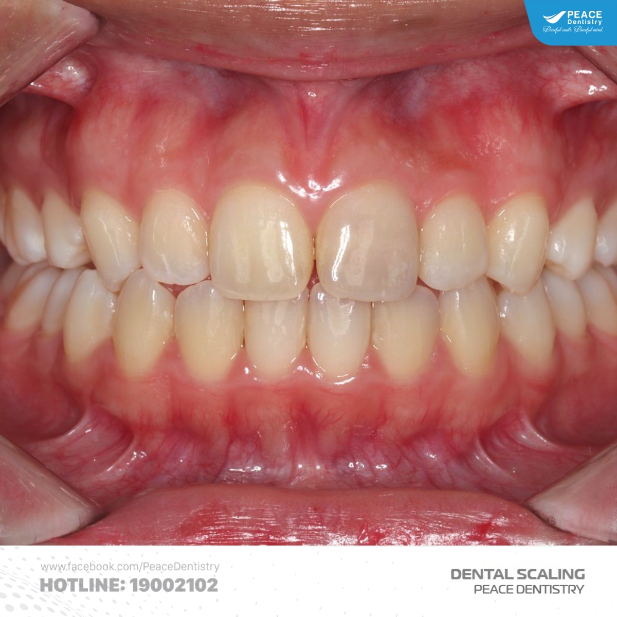 cảm giác hở kẽ răng sau khi cạo vôi