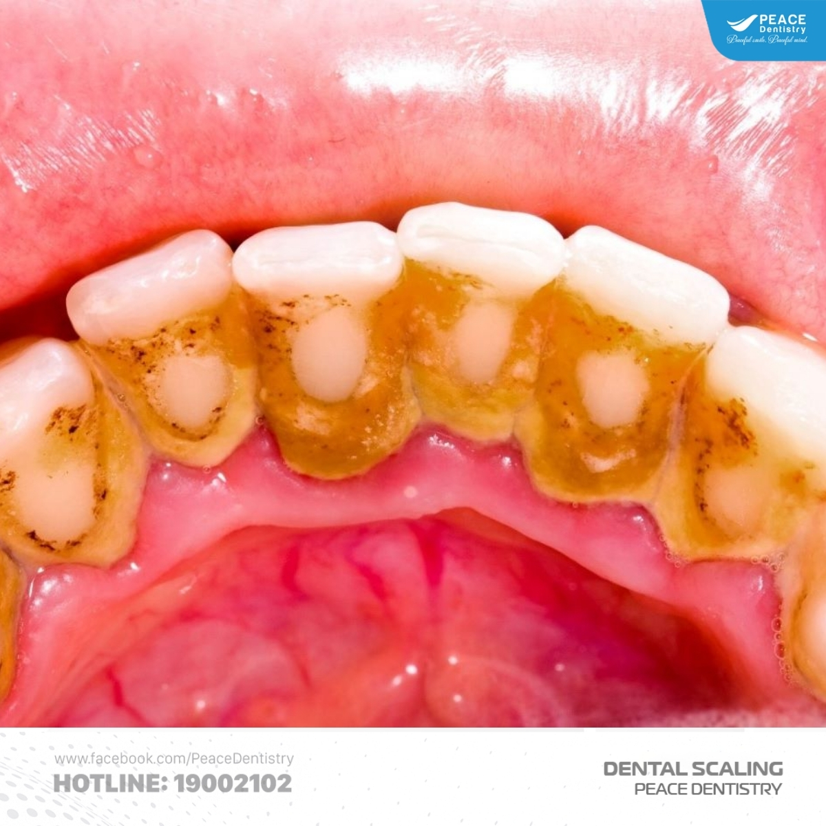 cao răng cấp độ 3