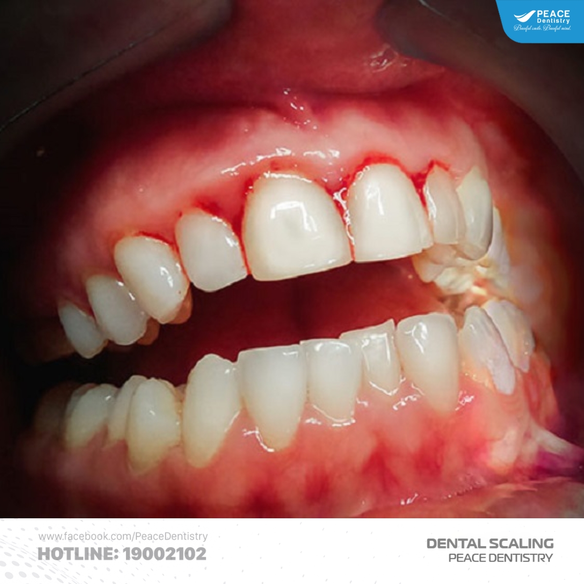 cao răng độ 4 có nguy hiểm không