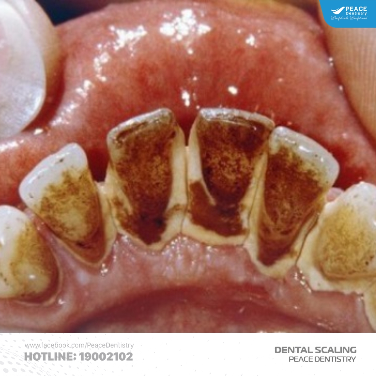 cao răng mức độ 4